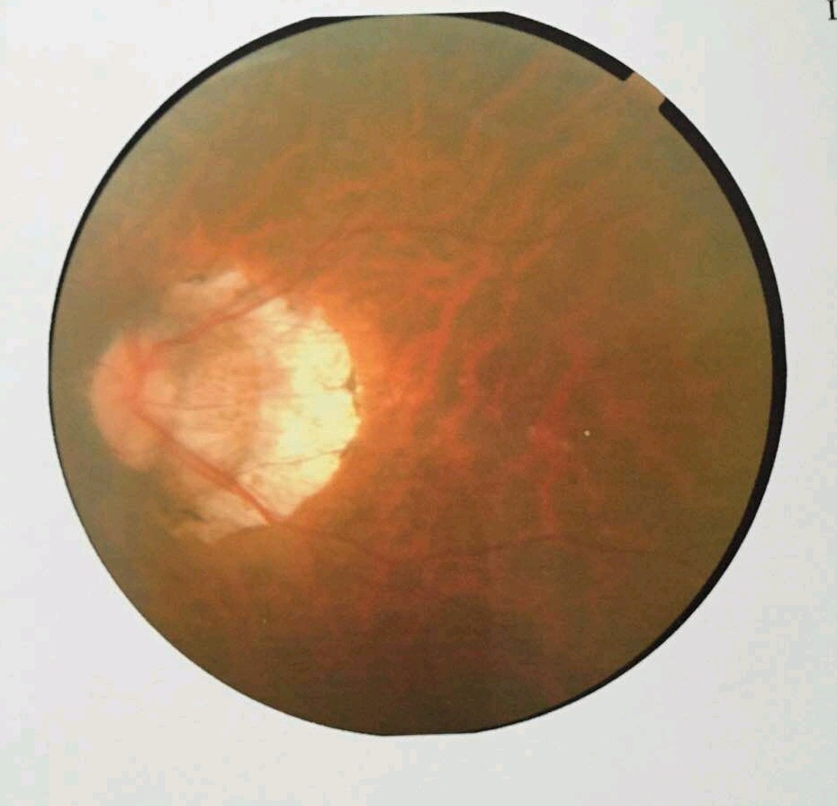 关键词 高度近视;准分子激光;黄斑前膜;后巩膜葡萄肿 病例详情